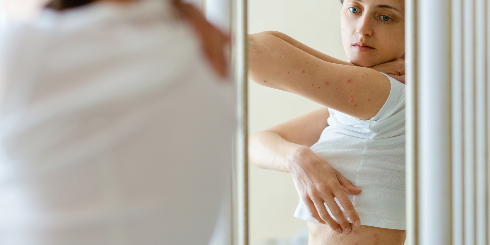a white girl looking at the stress rash on her body in the mirror with her top raised  